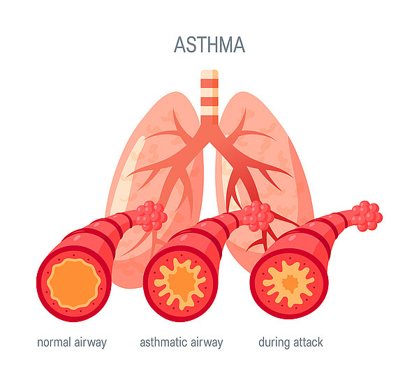 Graphik einer Lunge über Asthma.
